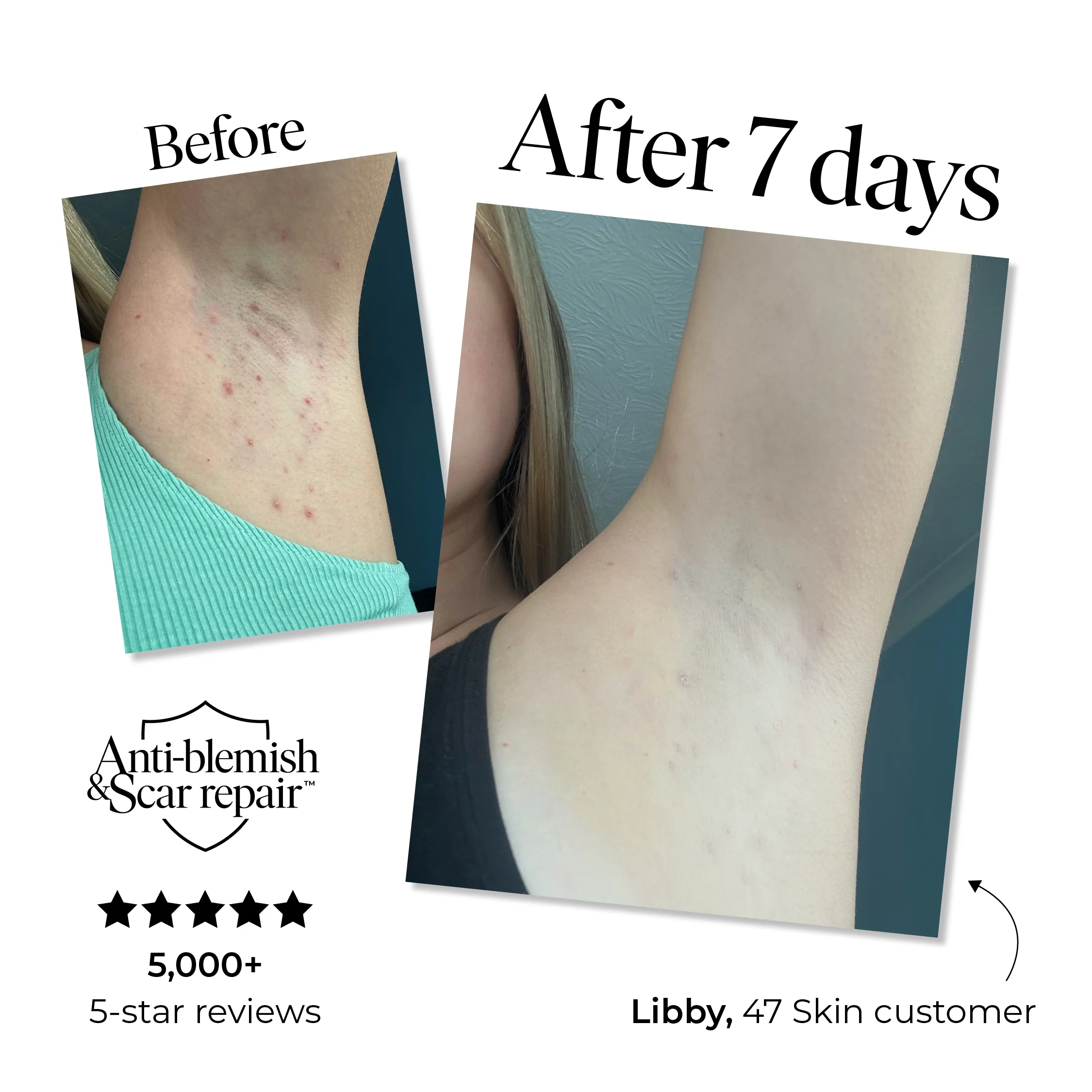 Anti-Blemish & Scar Repair Body Moisturiser - Image 4